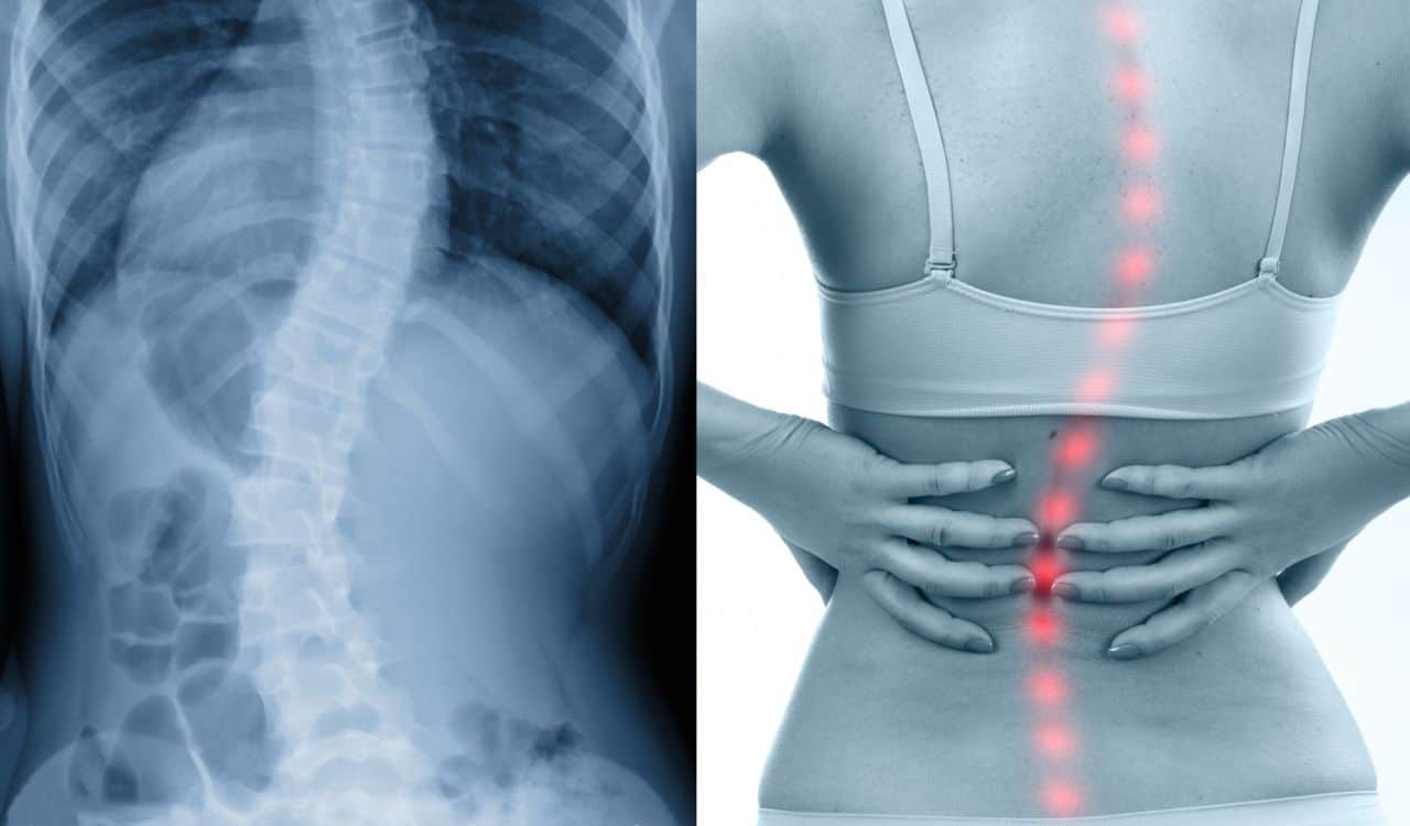 Scoliosis