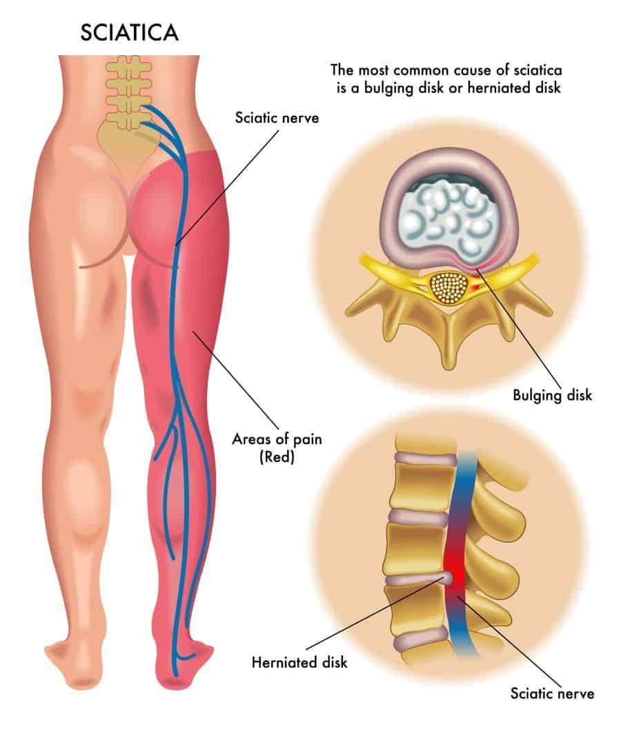 Do Inversion Tables Help Sciatica Thefitbay