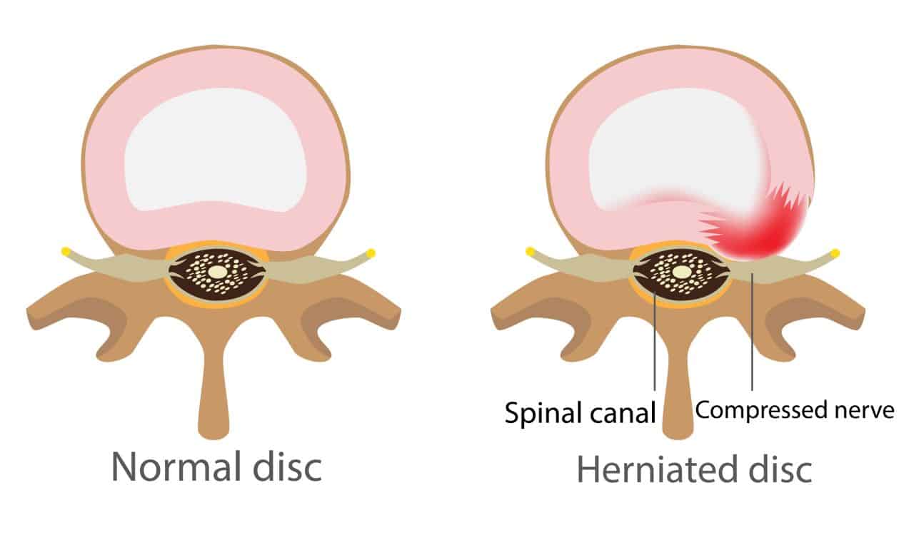 Normal Disc And Herniated Disc