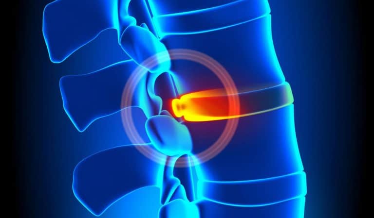 Does Traction Help Lower Back Pain? – TheFitBay