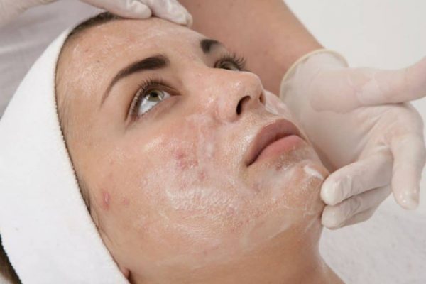 we reviewed the best glycolic acid peels on the market